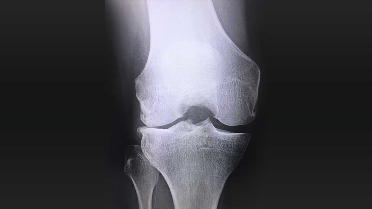 【医師執筆】レントゲンだけで変形性膝関節症と診断できますか?