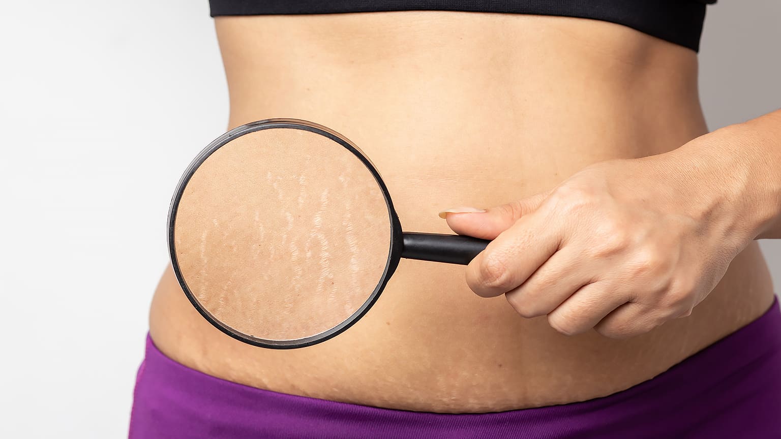 【医師監修】肉割れとは?予防と改善方法を徹底解説