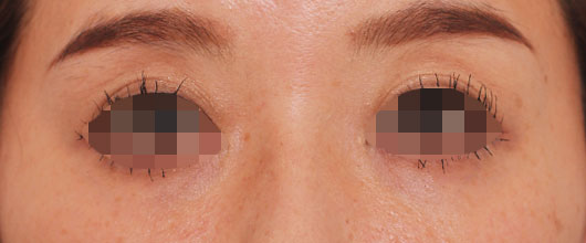 【30代女性】肌の再生医療による目の周りの治療 症例写真