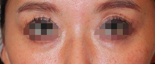 【30代女性】肌の再生医療による目の周りの治療 症例写真