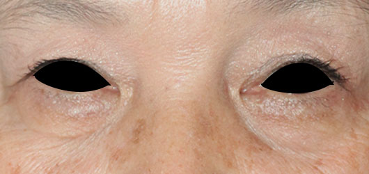 【70代女性】肌の再生医療による目の下のクマの治療 症例写真