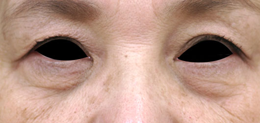 【70代女性】肌の再生医療による目の下のクマの治療 症例写真