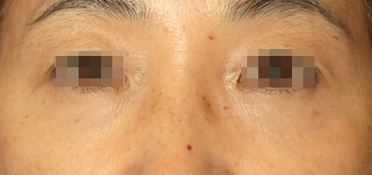 【50代女性】肌の再生医療による目の下のクマの治療 症例写真