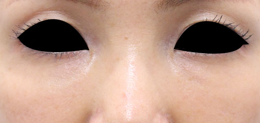 【40代女性】肌の再生医療による目の下のクマの治療 症例写真