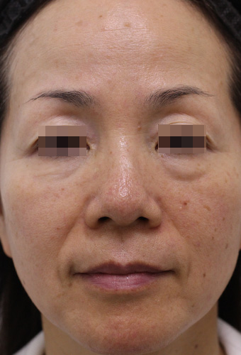 【50代女性】肌の再生医療による顔全体の治療 症例写真