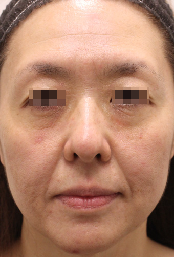 【50代女性】肌の再生医療による顔全体の治療 症例写真