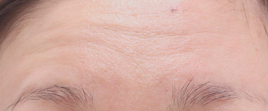 【30代女性】肌の再生医療によるおでこのシワの治療 症例写真