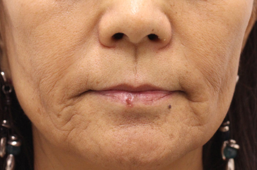 【60代女性】肌の再生医療による口周りの治療 症例写真