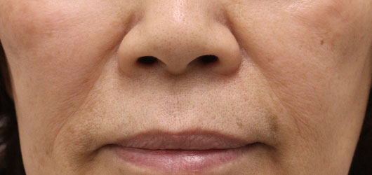 【70代女性】肌の再生医療によるほうれい線の治療 症例写真