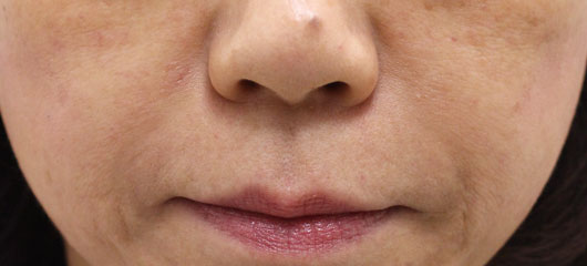 【50代女性】肌の再生医療によるほうれい線の治療 症例写真
