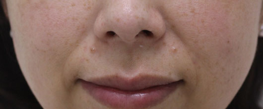 【40代女性】肌の再生医療によるほうれい線の治療 症例写真