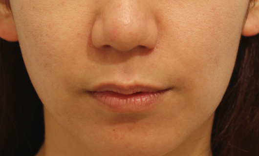 【30代女性】肌の再生医療によるほうれい線の治療 症例写真