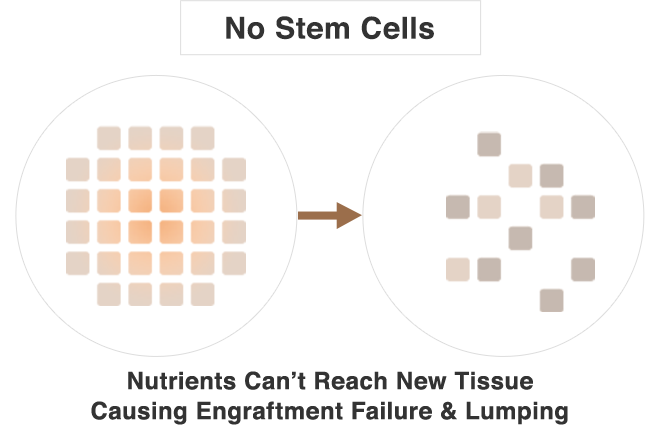 No Stem Cells: Nutrients Can’t Reach New Tissue Causing Engraftment Failure & Lumping