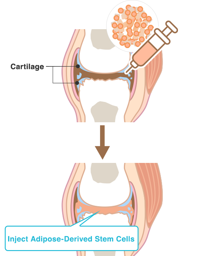 Inject Adipose-Derived Stem Cells