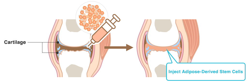 Inject Adipose-Derived Stem Cells